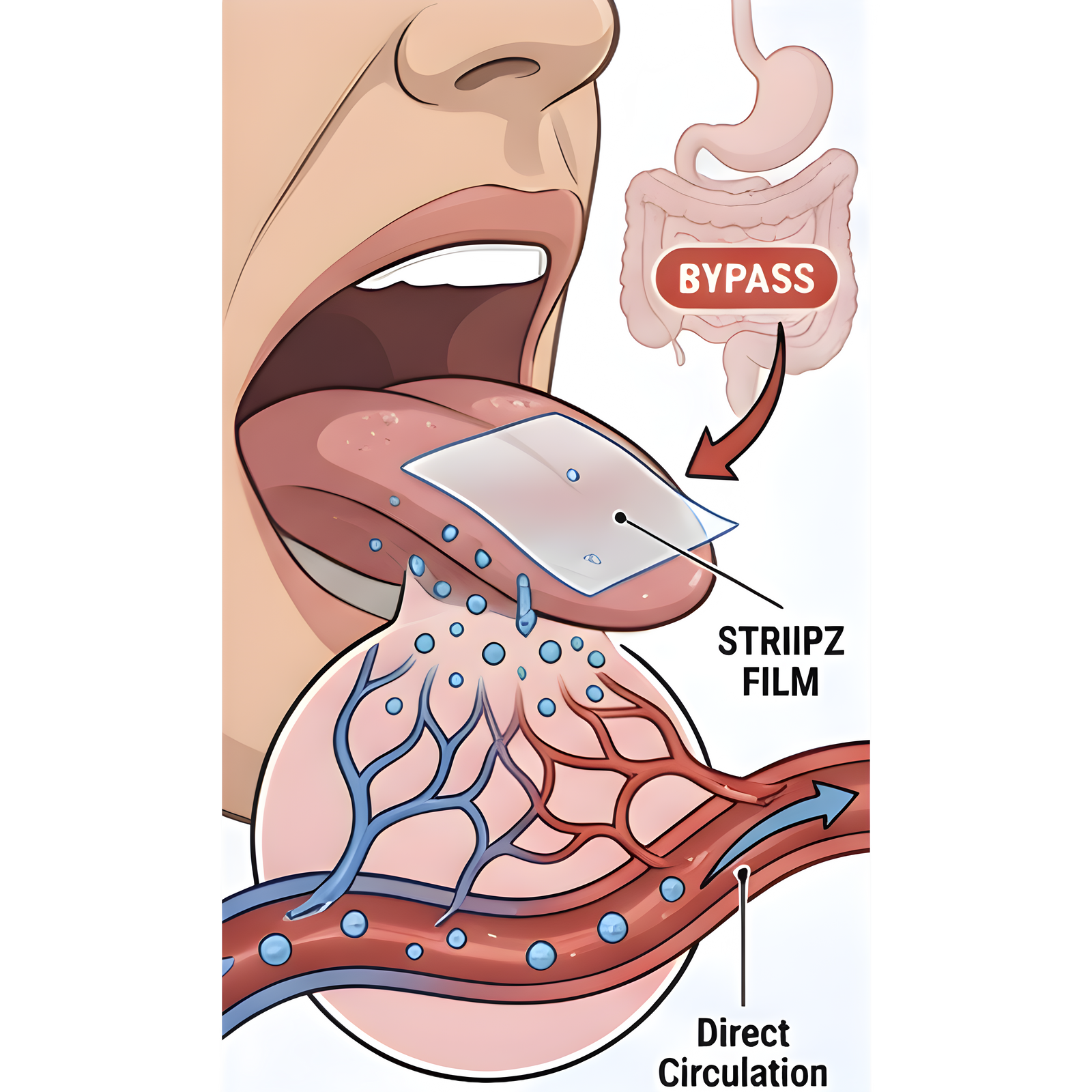 Diagram of a medical procedure involving a bypass and STRIPZ film application.